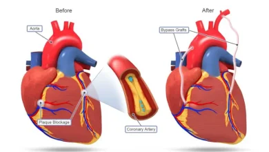 冠動脈バイパス移植（CABG）市場における最新のトレンドと成長要因を探ります。技術の進歩と心血管疾患の増加が、2030年までの世界のCABG市場をどのように形成していくかを理解しましょう。